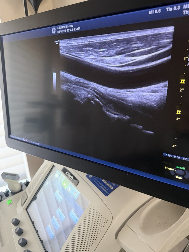 GE ML6-15 D Linear Vascular Probe , Excellent working condition,