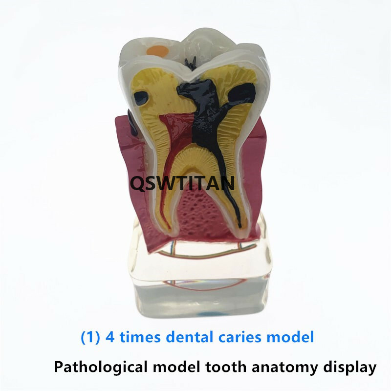 Teeth Model 4 times tooth pathology model Periodontal Teaching Study model