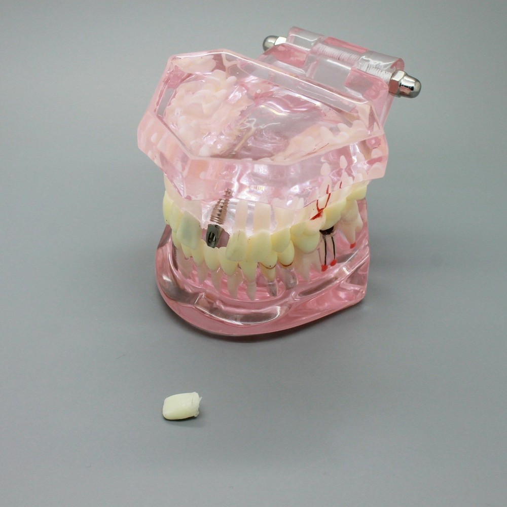 Dental Teeth Model Implant Study Demonstration Restoration Bridge & Crown