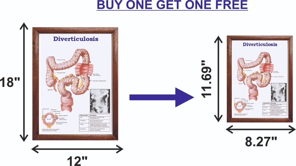 Diverticulosis Chart 12x18 inches