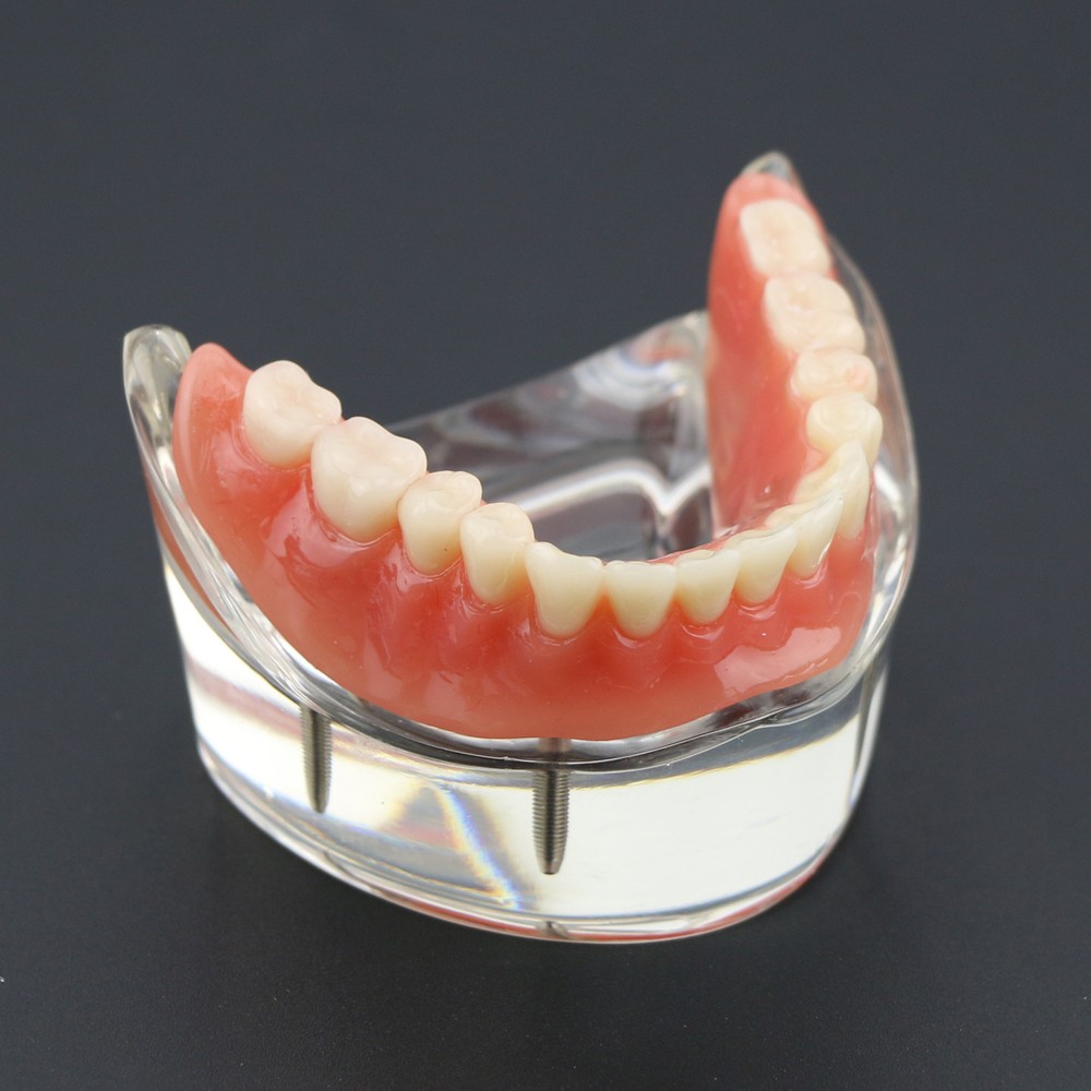 Dental Typodont Lower Teeth Demo Study Model Overdenture Inferior 4 Implants
