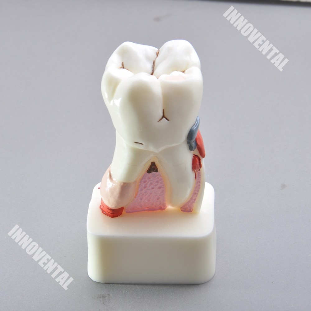 Dental Model #4015 01 - Pathological Molar Study Model