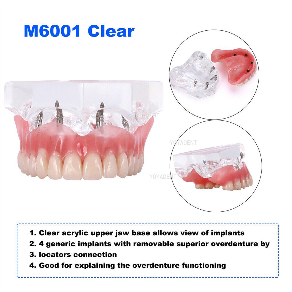 Dental Model 4 Implants superior/Mandibular Removable Overdenture Teeth Model