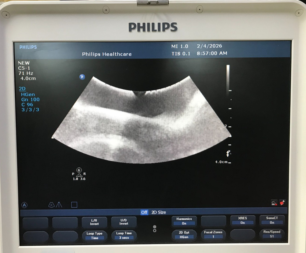 Philips C5-1 Curved Array Convex Abdominal Probe Transducer