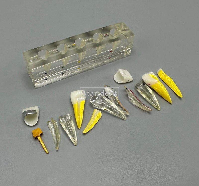 Dental Caries Teeth Model Detachable Abutment Teaching Study Models 4 times