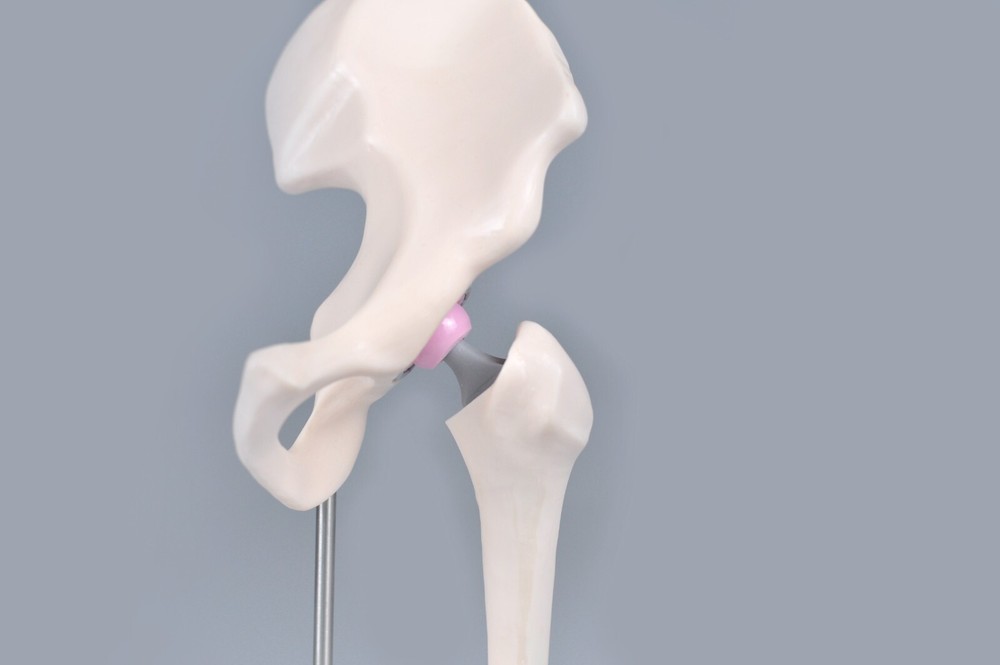 1/3 Artificial Hip Joint Replacement Anatomical Skeleton Demo Display Model