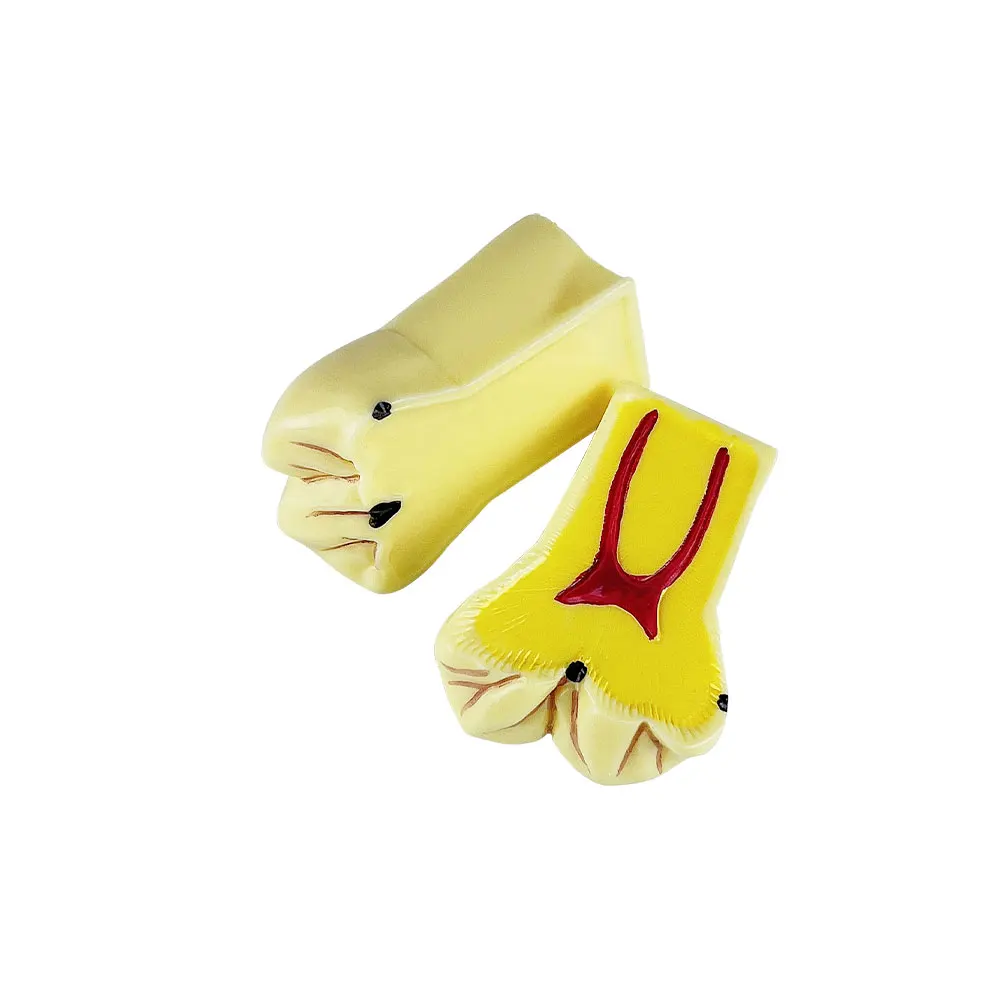 Dental 4 Times Caries Evolution Model Tooth Decay Comparsion Demonstration Model