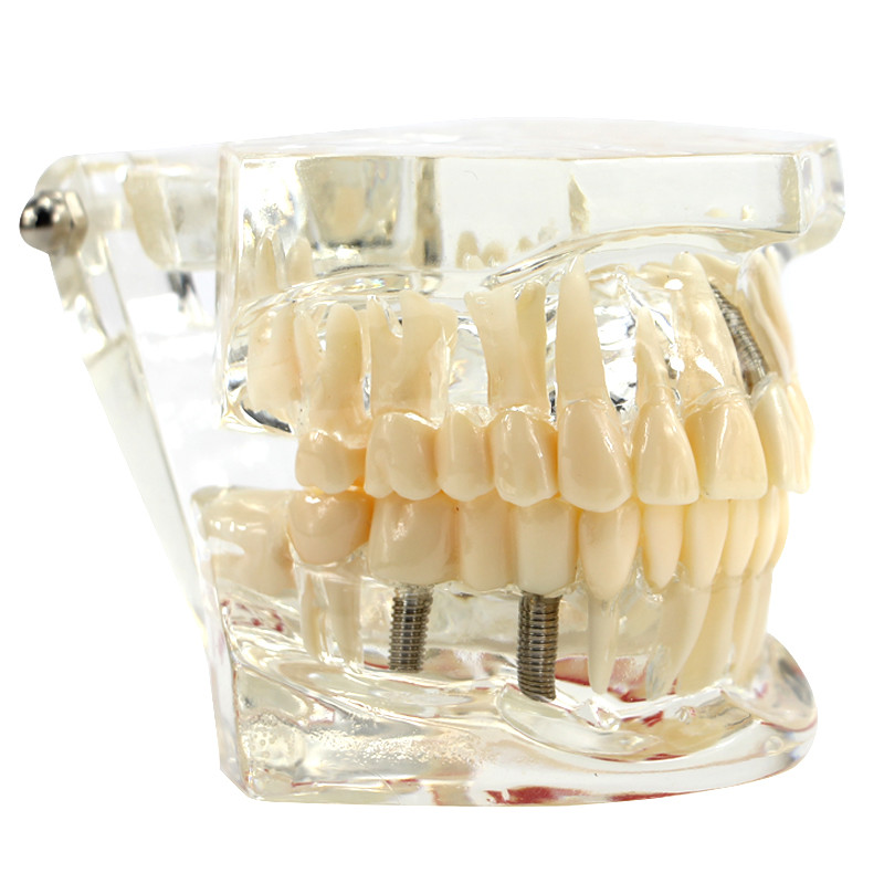 Dental Transparent Pathological Teeth Study Model Implant and Restoration Model
