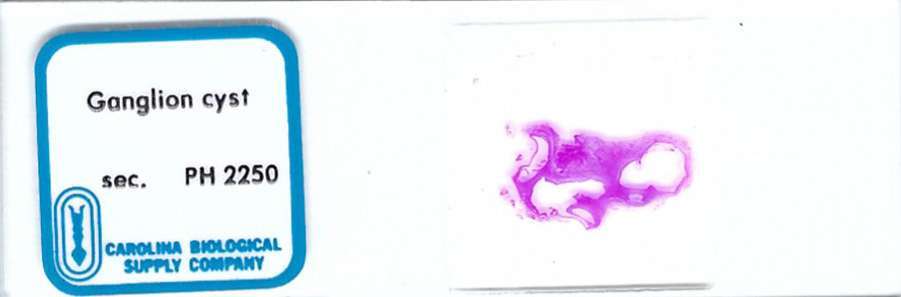 Human Ganglion Cyst Pathology Microscope Slide