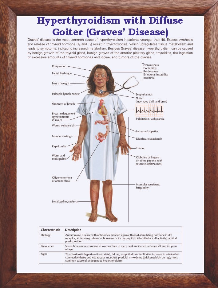 Hyperthyroidism with Diffuse Goiter Graves’ Disease) Chart 12x18 inches