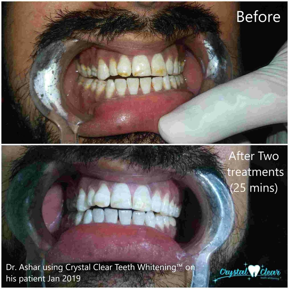 Kit Blanqueamiento Dental Calidad DDS. Recargable
