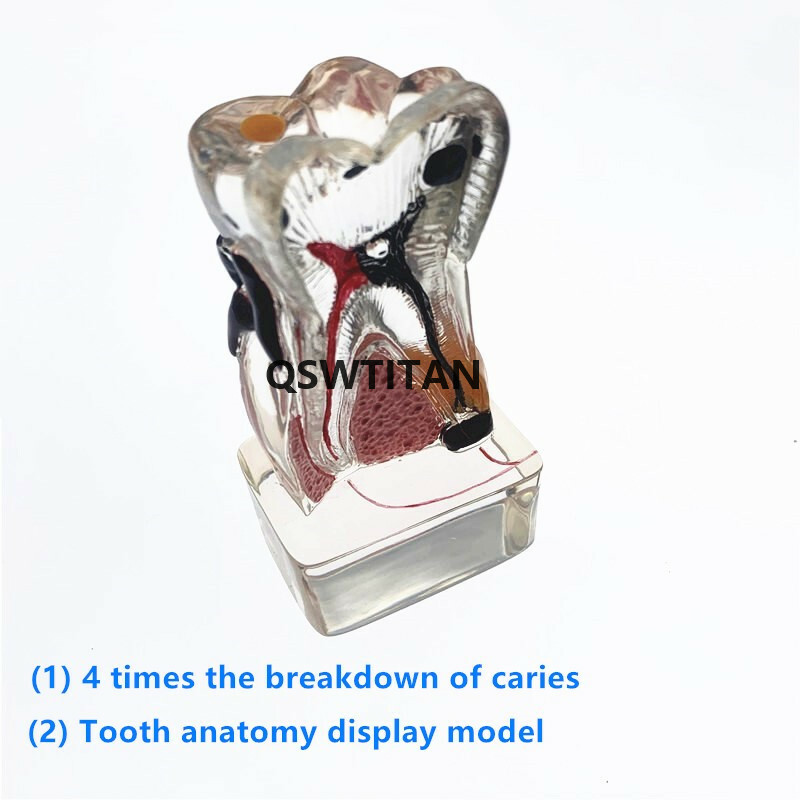 Teeth Model 4 times tooth pathology Comprehensive Periodontal teaching models