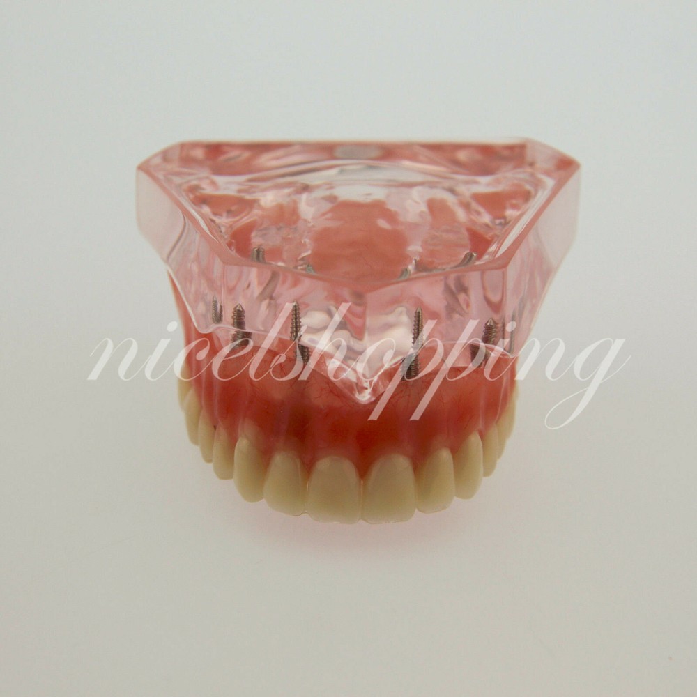 Dental Overdenture Teeth StudyInferior 4 Implant Demo Model Teaching Study