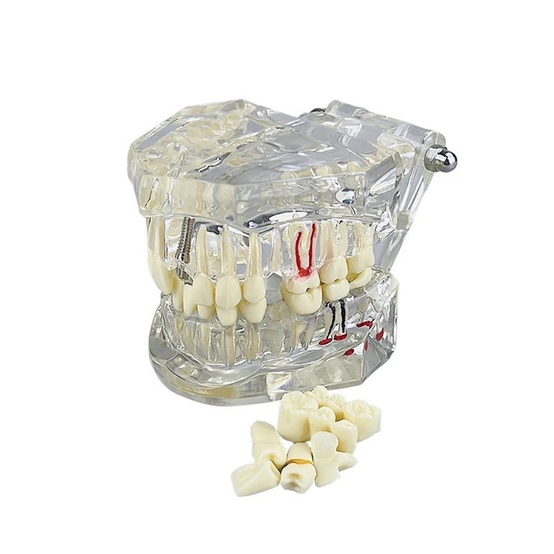 Dental Removable Restoration &Implant Pathological Disease Teeth Study Model