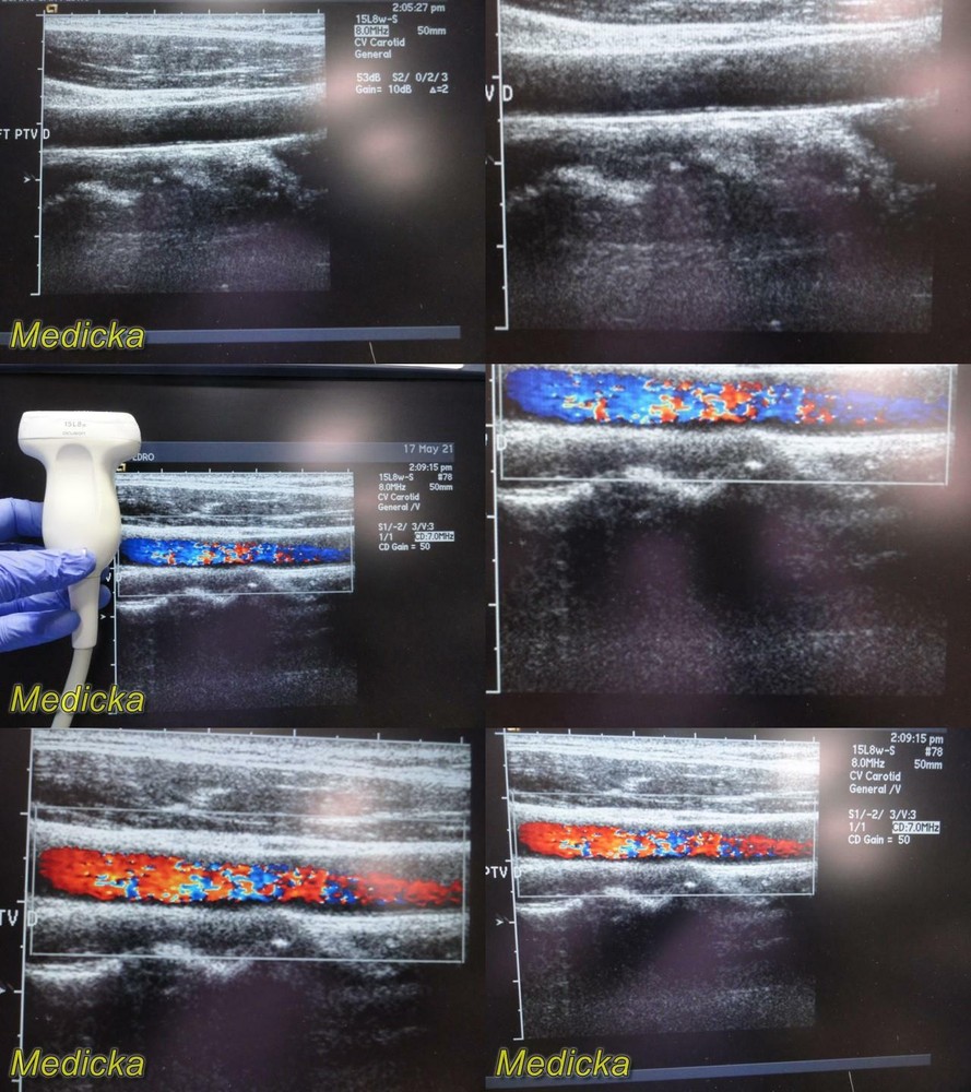 Acuson Model 15L8W Linear Array Ultrasound Transducer Probe ~ 24856