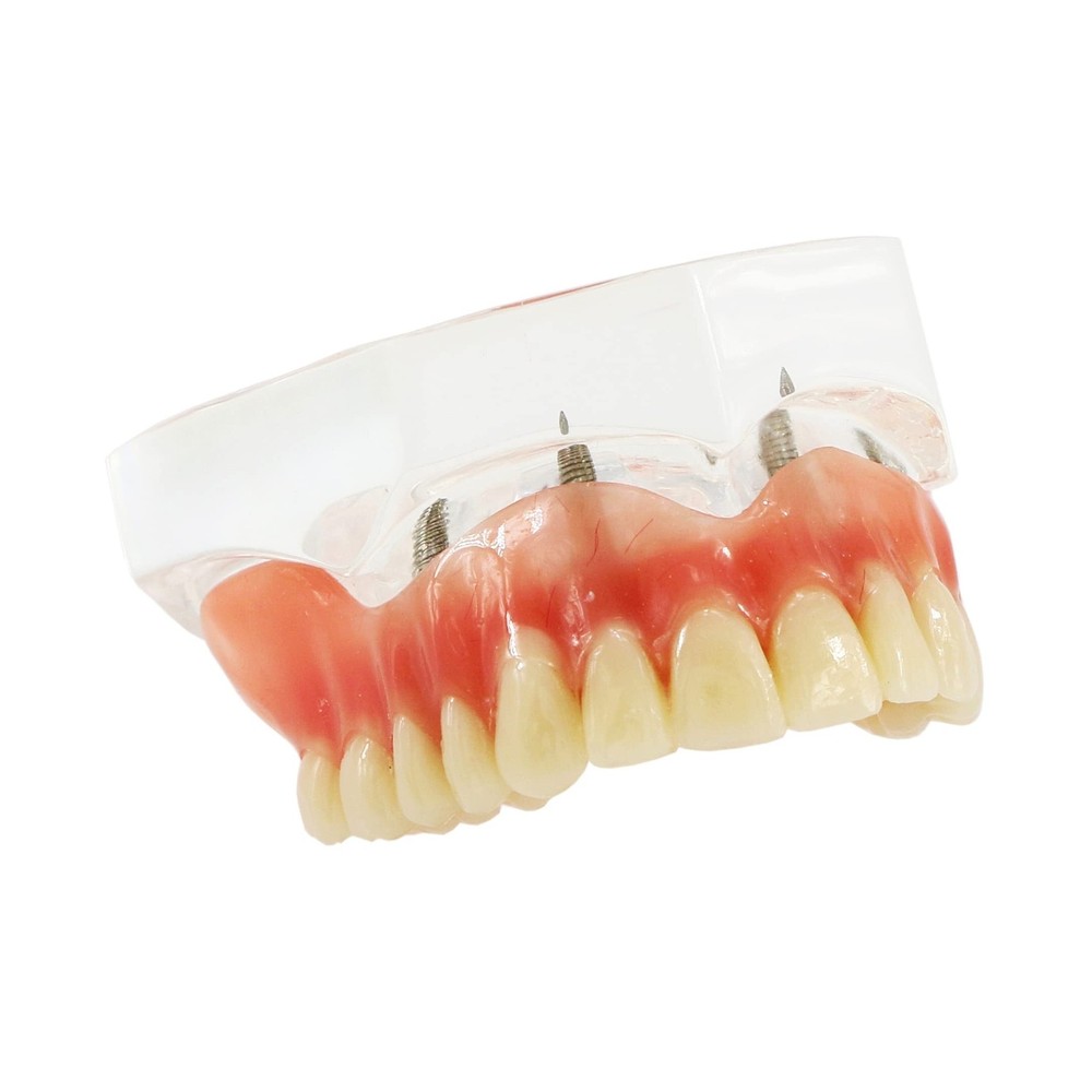 Dental Upper Implants Model Overdenture with 4 Superior Teeth Demo Transparen...