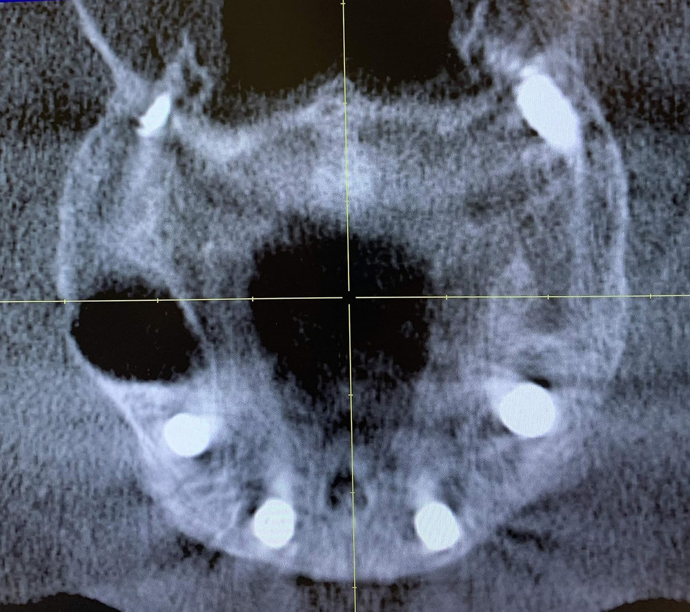 Pterygoid Implants: the Art and Science