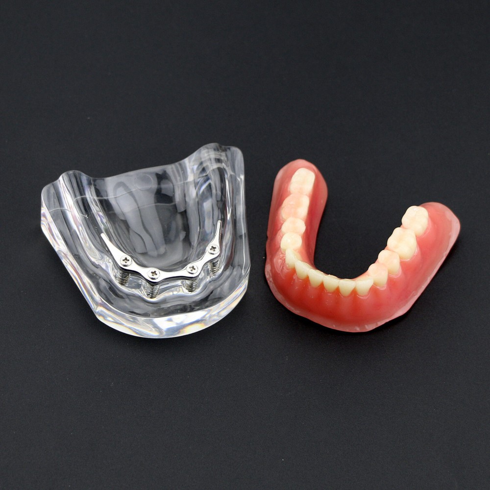 Dental Teeth Model Inferior Overdenture Precision 4 Implants Demo Silver Bar