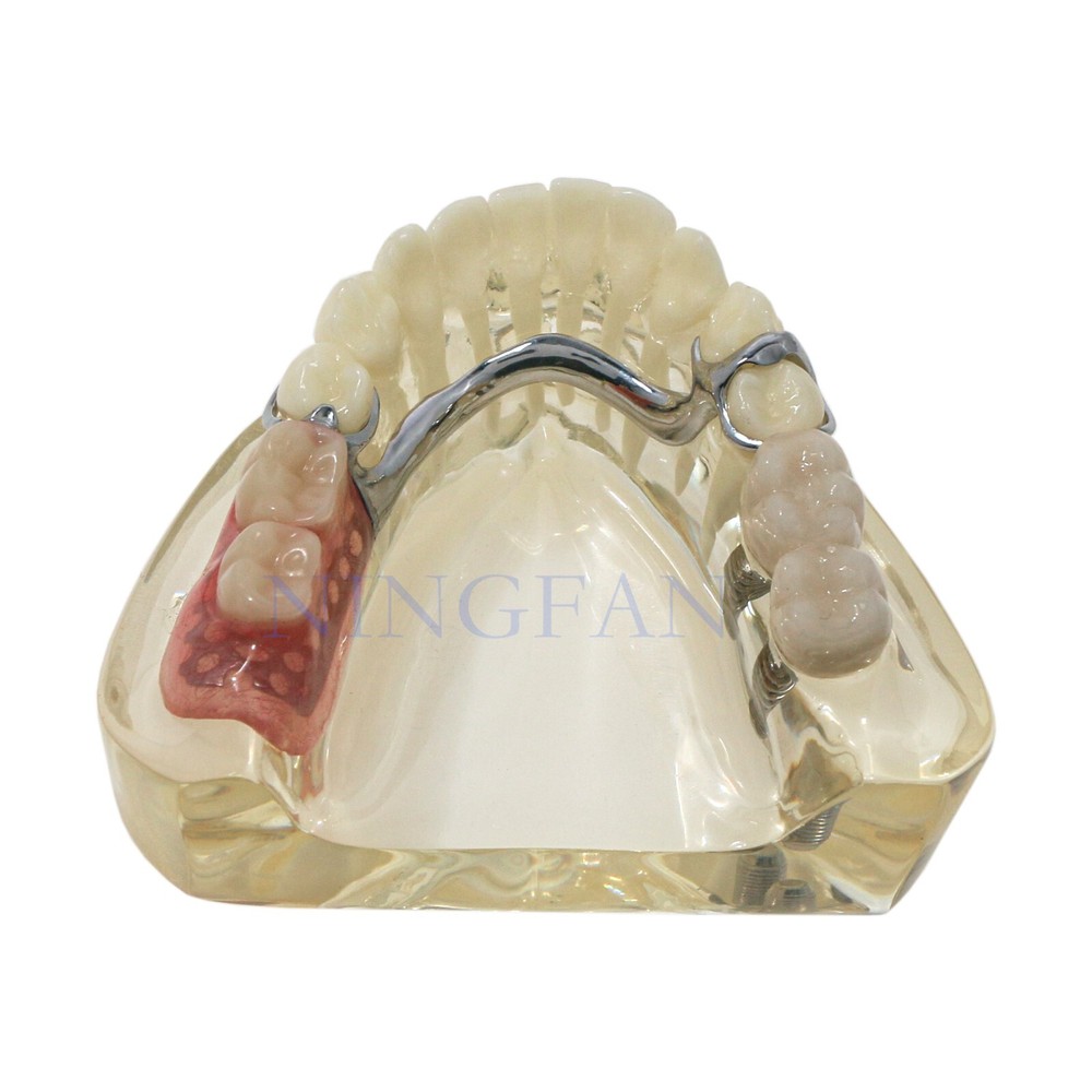 Dental Typodont Restoration Teeth Model With Partial Denture Demo 2 Implants