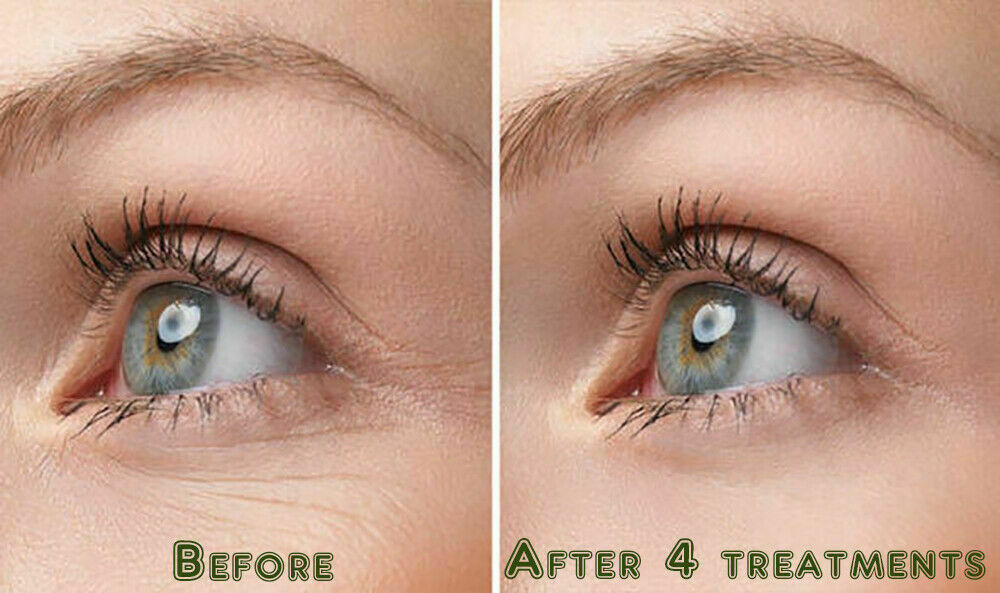 HYALURONIC ACID 100% Pure Anti Aging Hydrating Serum, Plumps Wrinkles Fine Lines