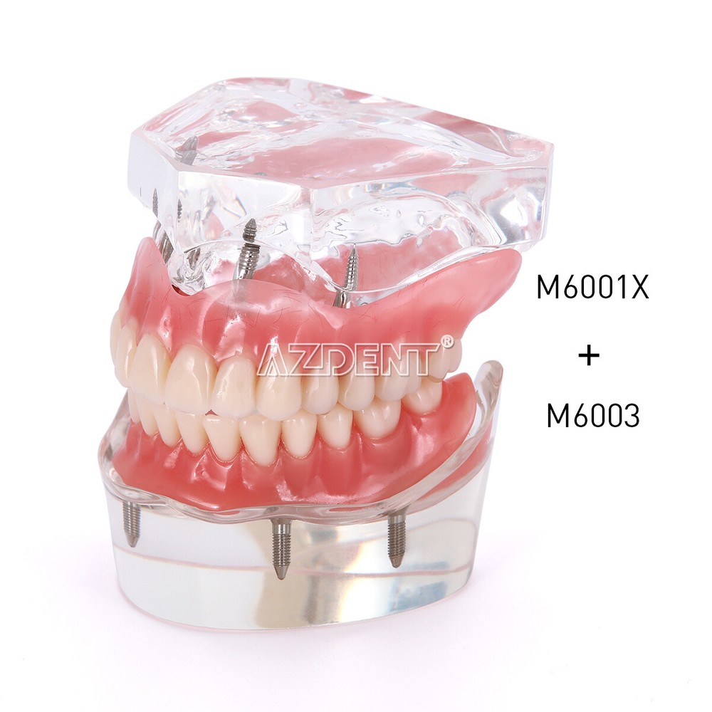 Dental Implant Teach Study Model Demo Overdenture Typodont 4Implants Upper Lower