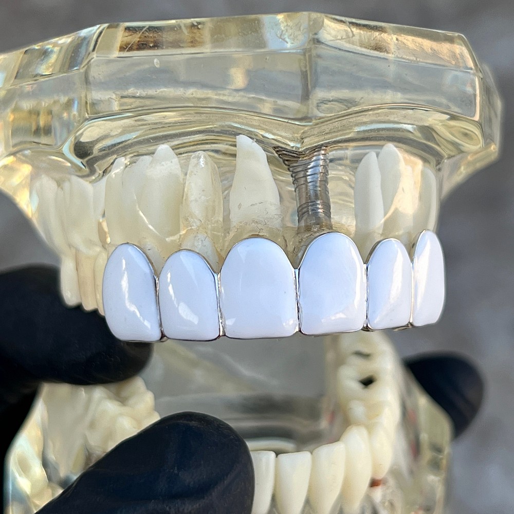 Real Solid 925 Sterling Silver White Enamel Grillz Rapper Grill Six Top Teeth