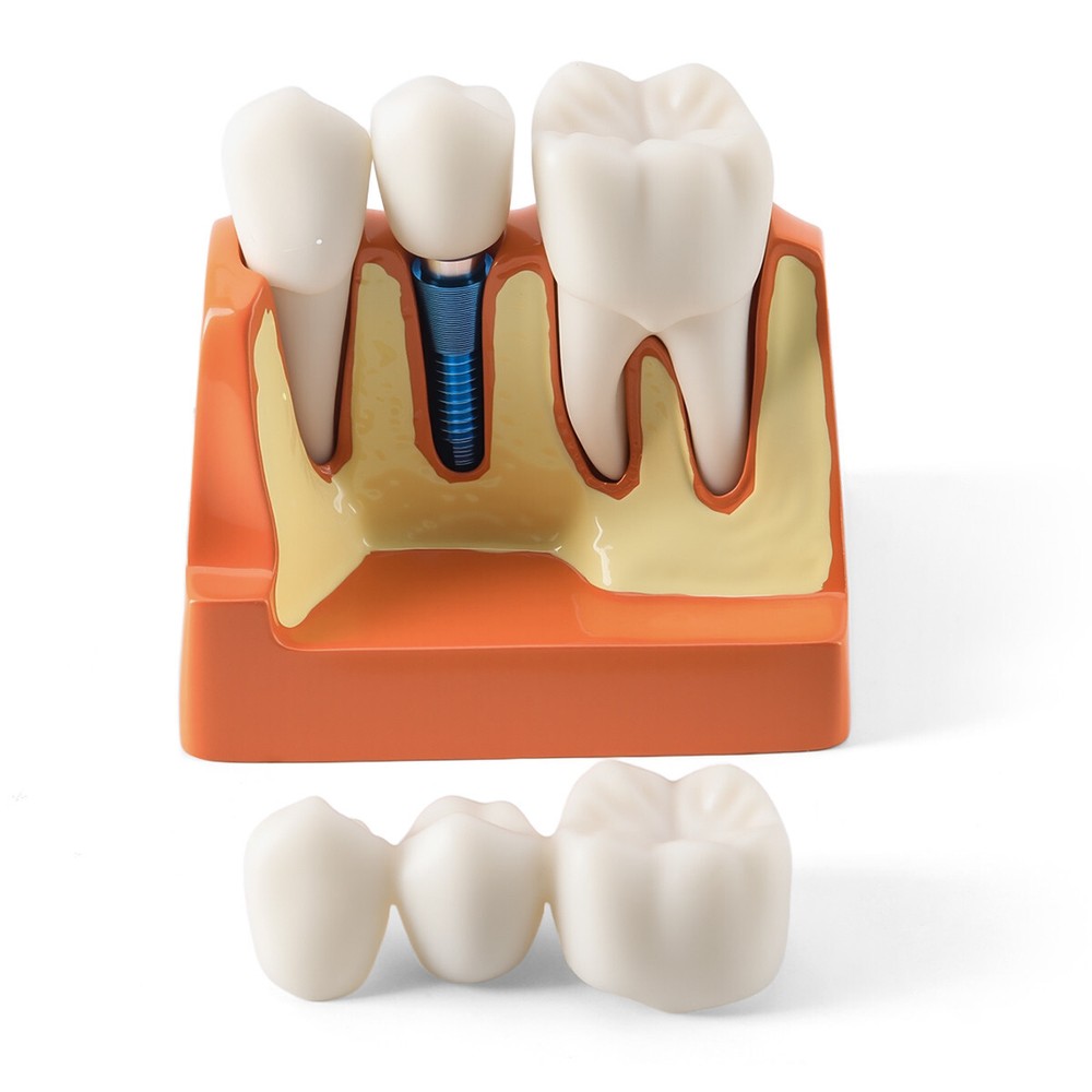 Dental 4Times Teeth Model Implant Analysis Crown Bridge Removable Study Training