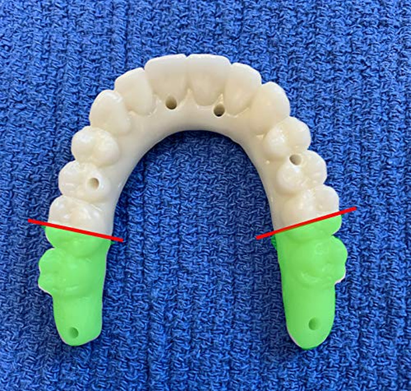 Pterygoid Implants: the Art and Science