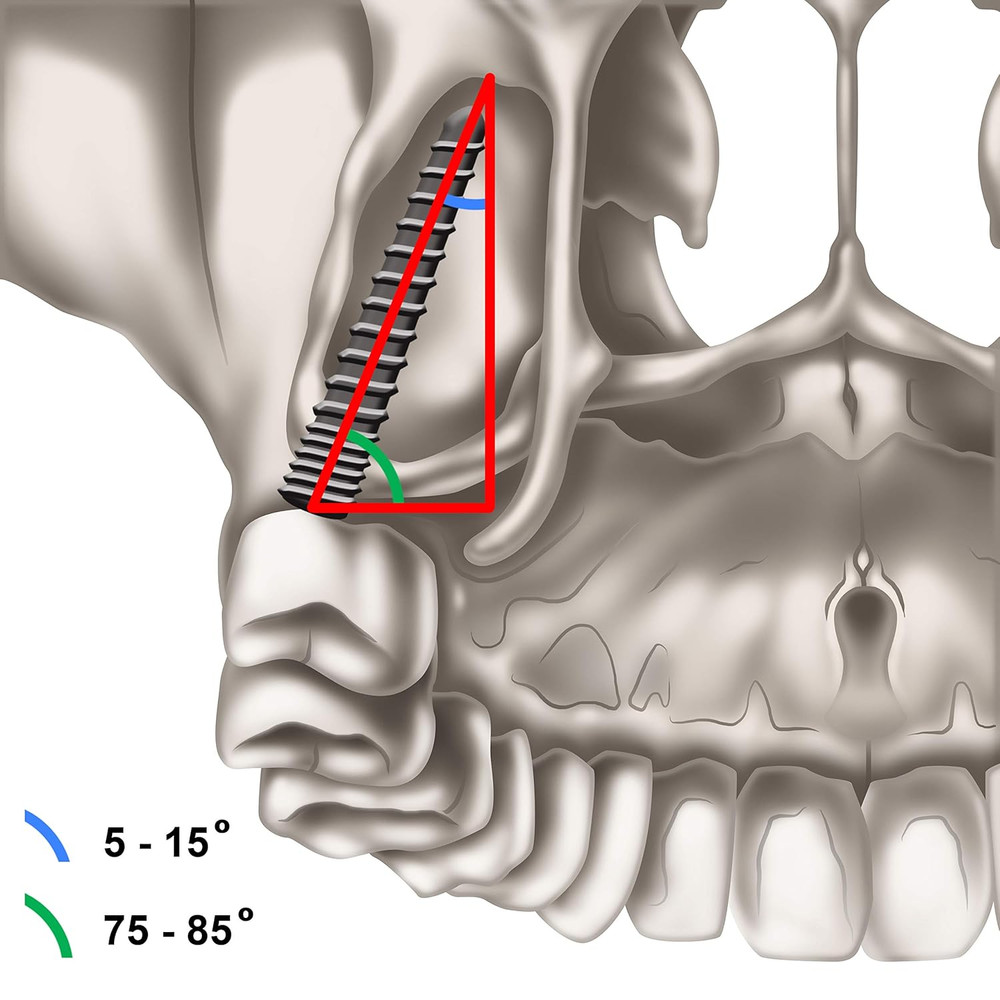 Pterygoid Implants: the Art and Science