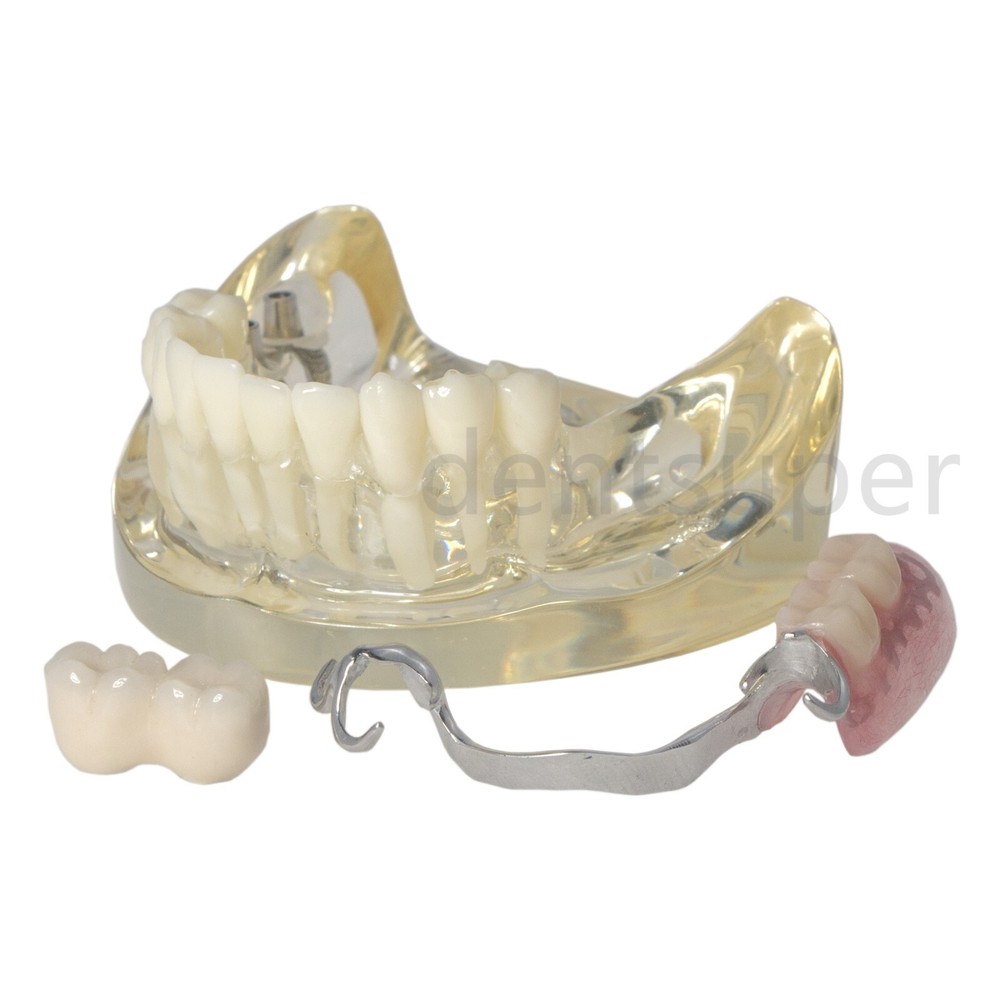 Typodont Restoration Dental Teeth Model With Partial Denture Demo 2 Implants