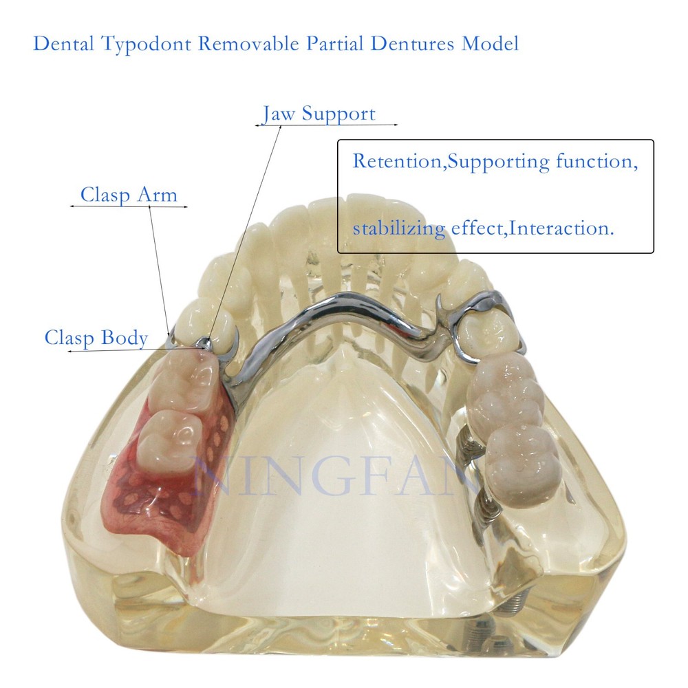 Dental Implant RPD Restoration Model Removable Partial Denture Lower 2 Implants