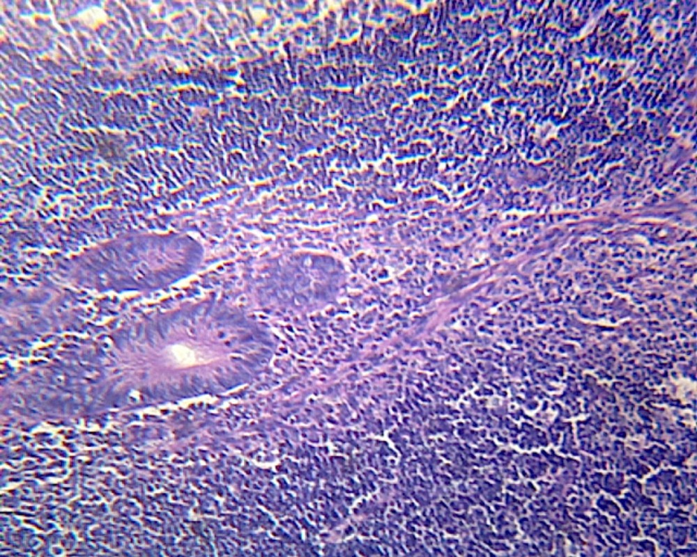 Vermiform Appendix; Section