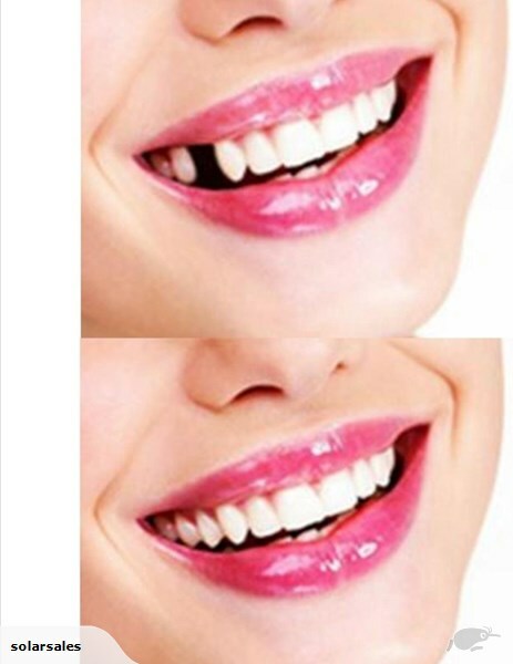 Thermal Fitting Beads, Fix Missing and Broken Teeth, Instant Smile –Pack 2