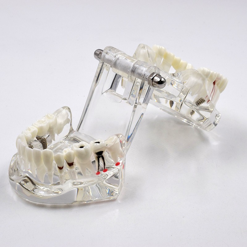 Dental Removable Restoration &Implant Pathological Disease Teeth Study Model