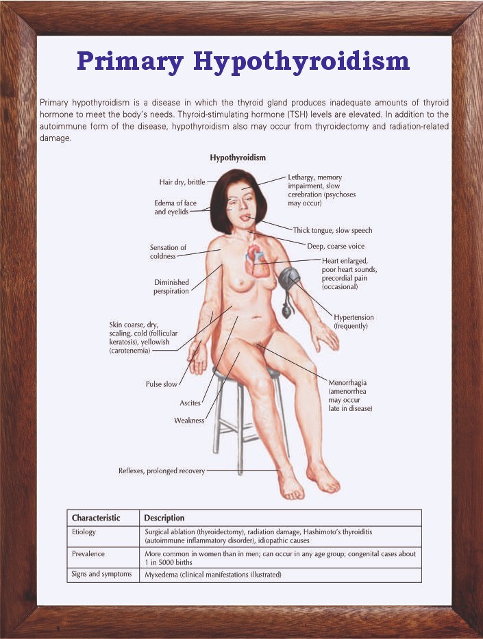 Primary Hypothyroidism Chart 12x18 inches