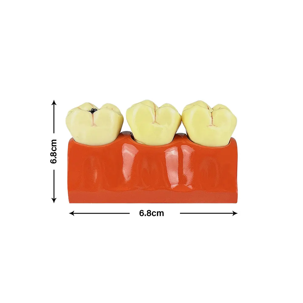 Dental 4 Times Caries Evolution Model Tooth Decay Comparsion Demonstration Model