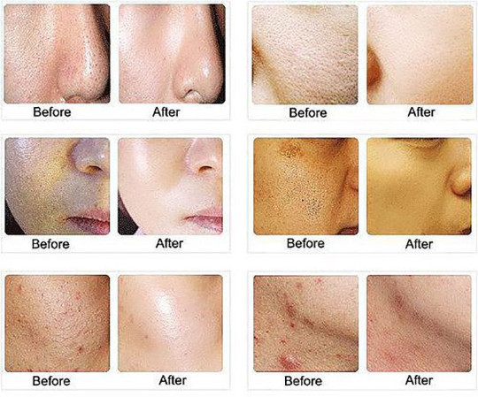 Lactic Acid Skin Peel For Acne Wrinkles Melasma Age Spots 25% 40% 50% 90%