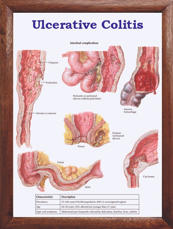 Ulcerative Colitis Chart 12x18 inches