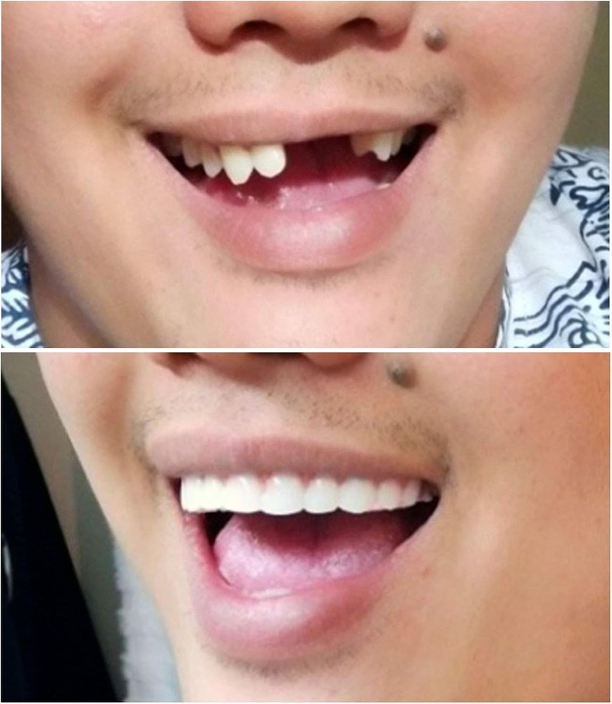 Easy Fitting Cosmetic Veneers - Comfortable Fit