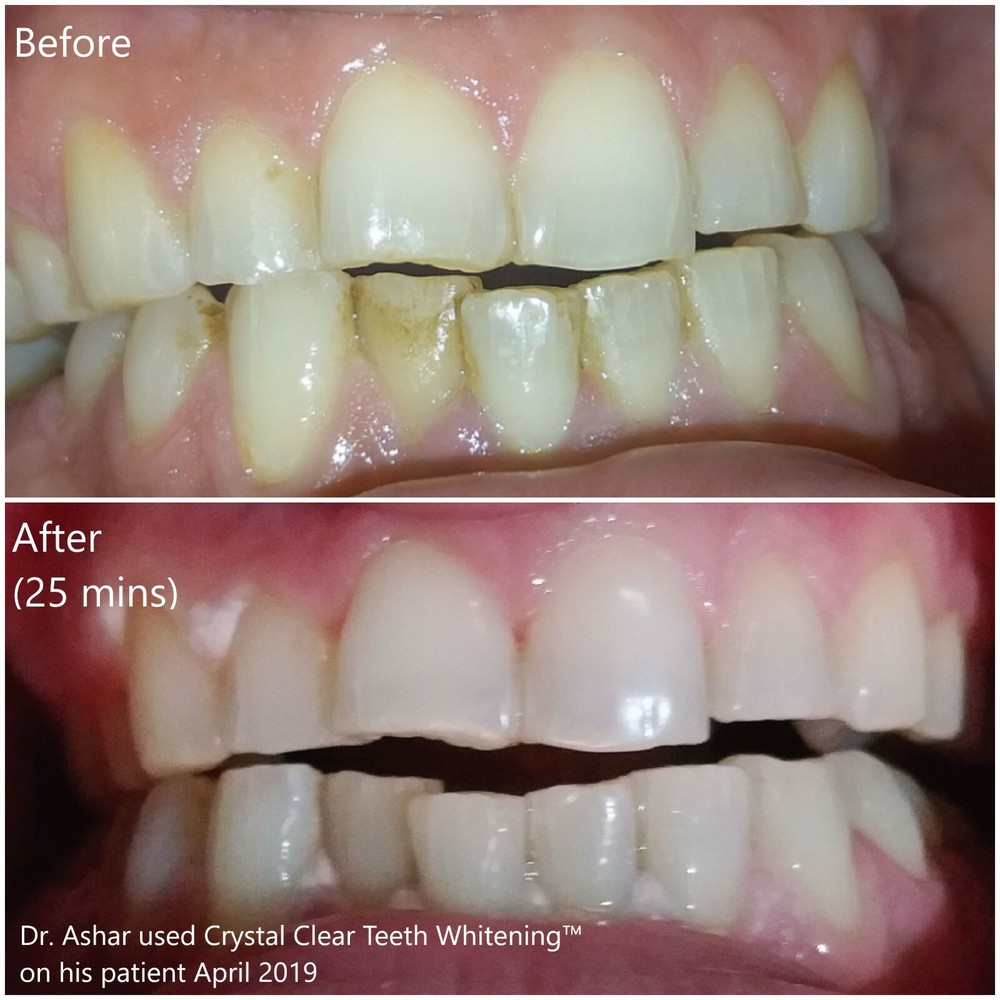 blanqueador de dientes. gel blanqueador de dientes