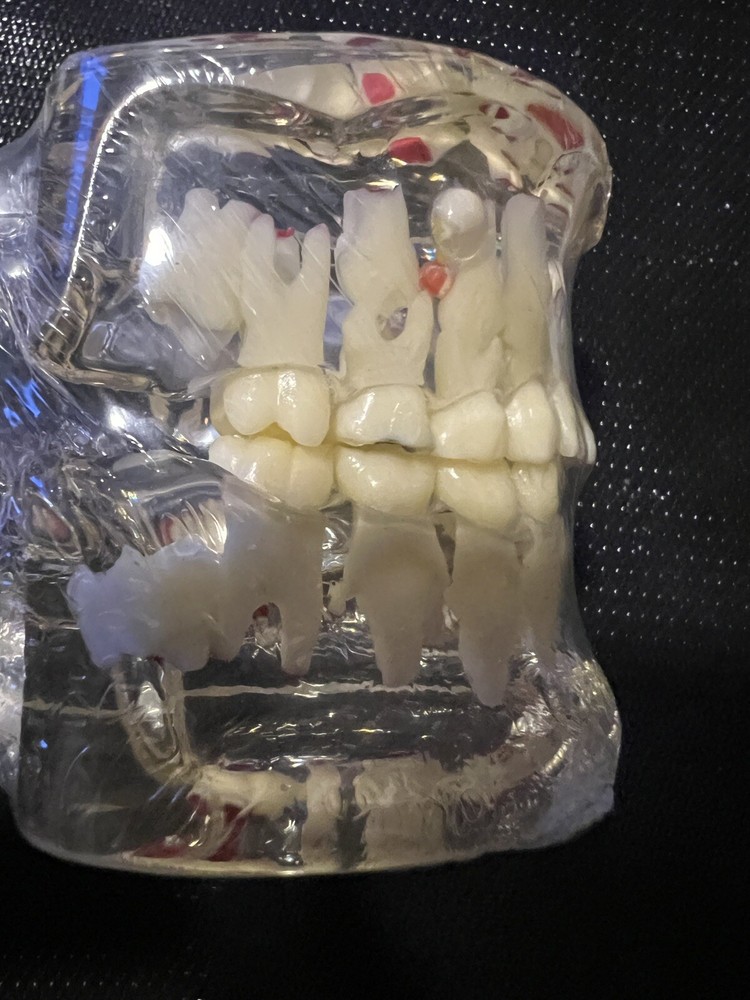 Dental Pathology Demonstration Study Tooth Teeth Model