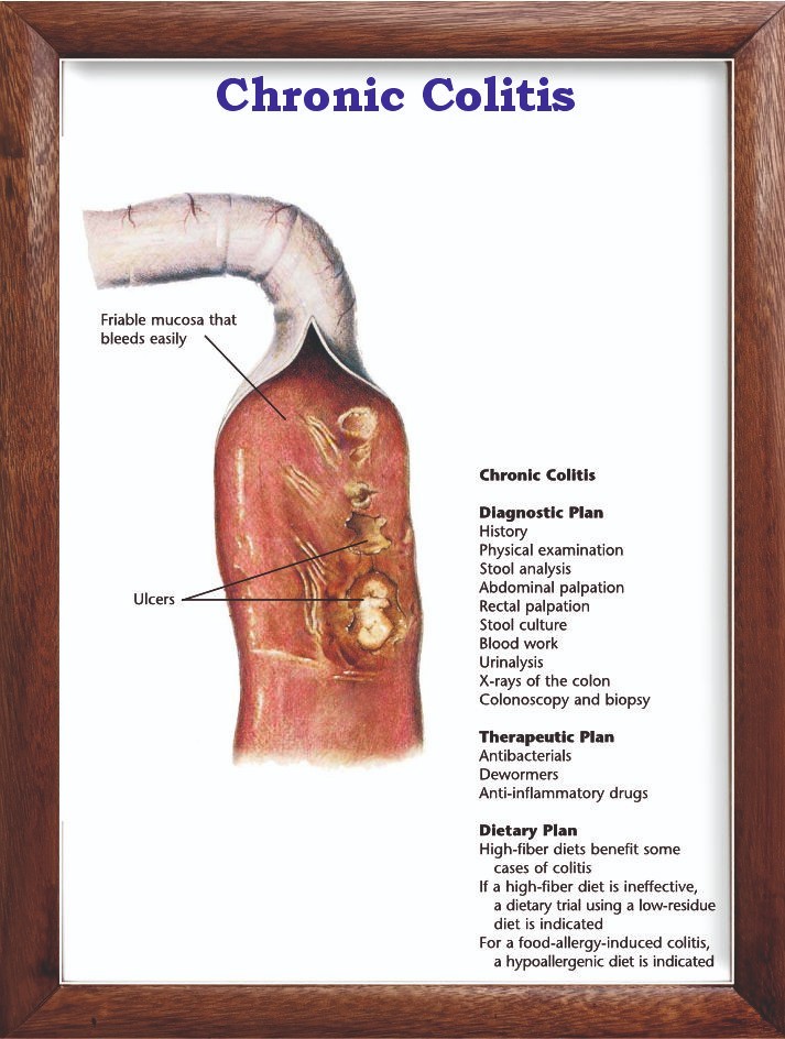 Chronic Colitis Chart 12x18 inches