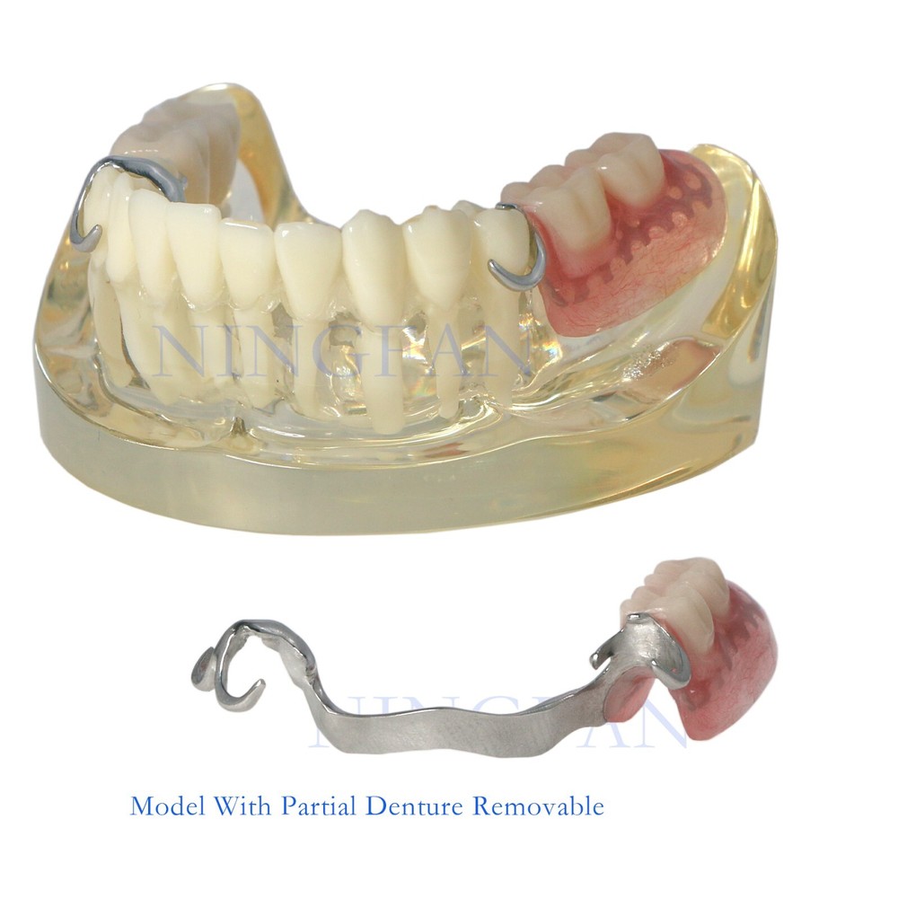 Dental Typodont Restoration Teeth Model With Partial Denture Demo 2 Implants