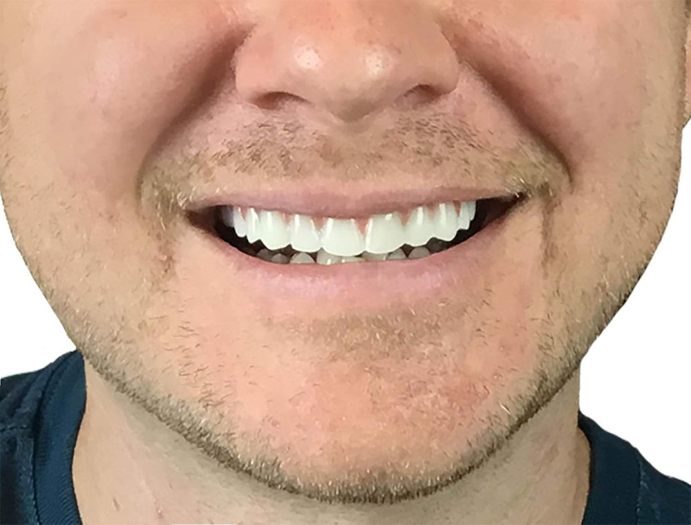 Flexible Upper Veneers for Natural Smile