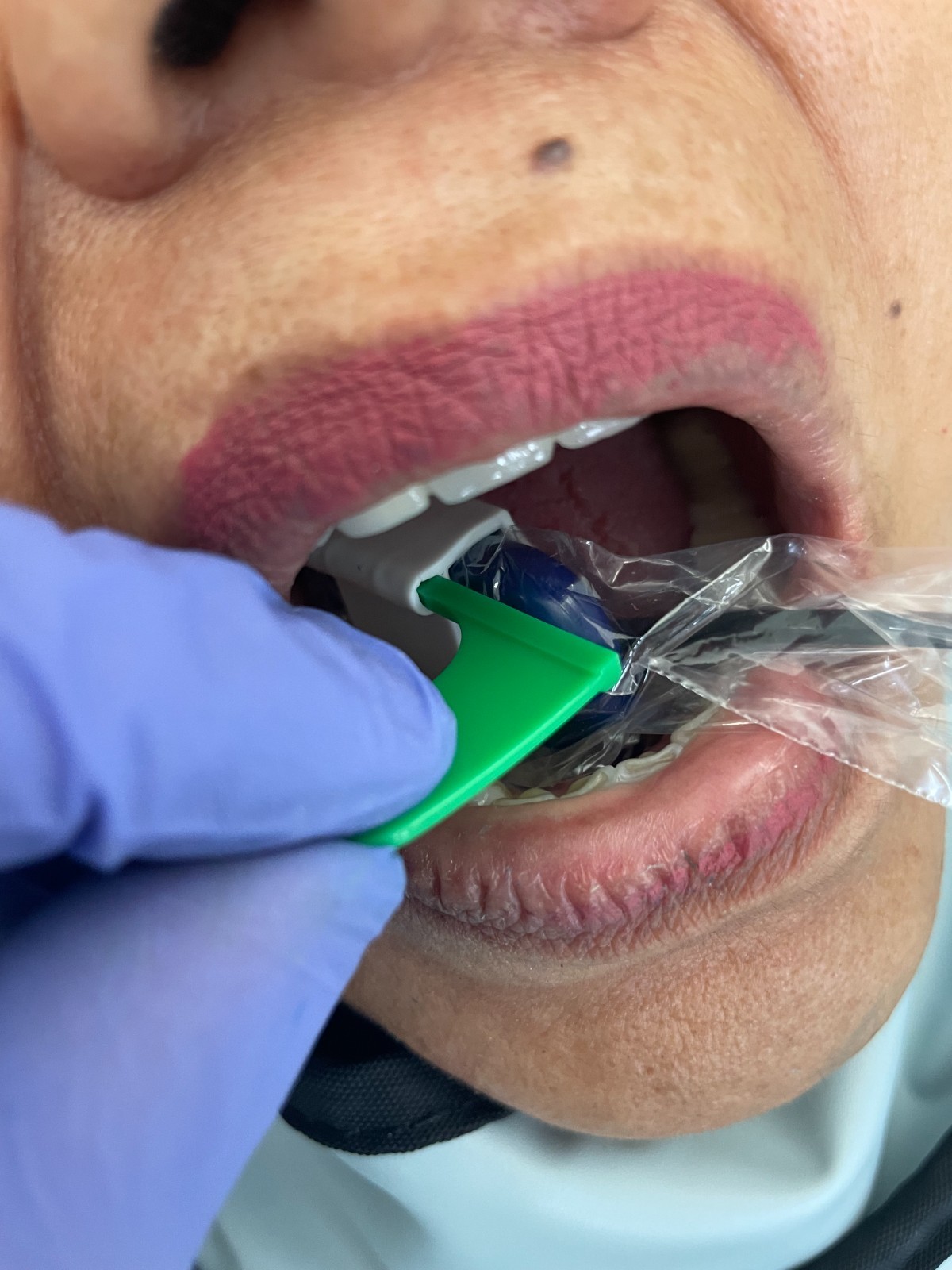 5 pcs Autoclavable - Apical/Bitewing Adult Digital Sensor Positioner-Holder