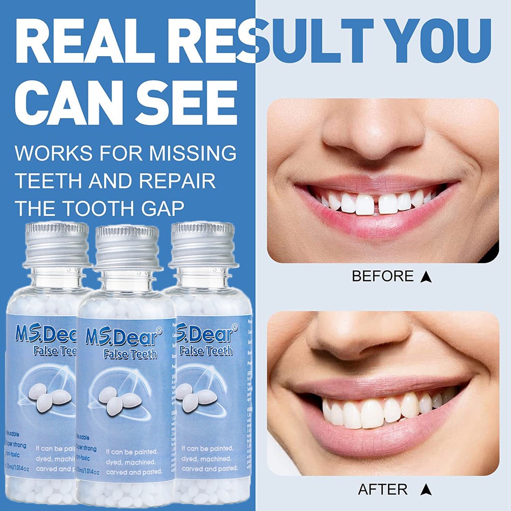 Tooth Repair Kit - Temporary Teeth Replacement Kit for Missing & Broken Teeth