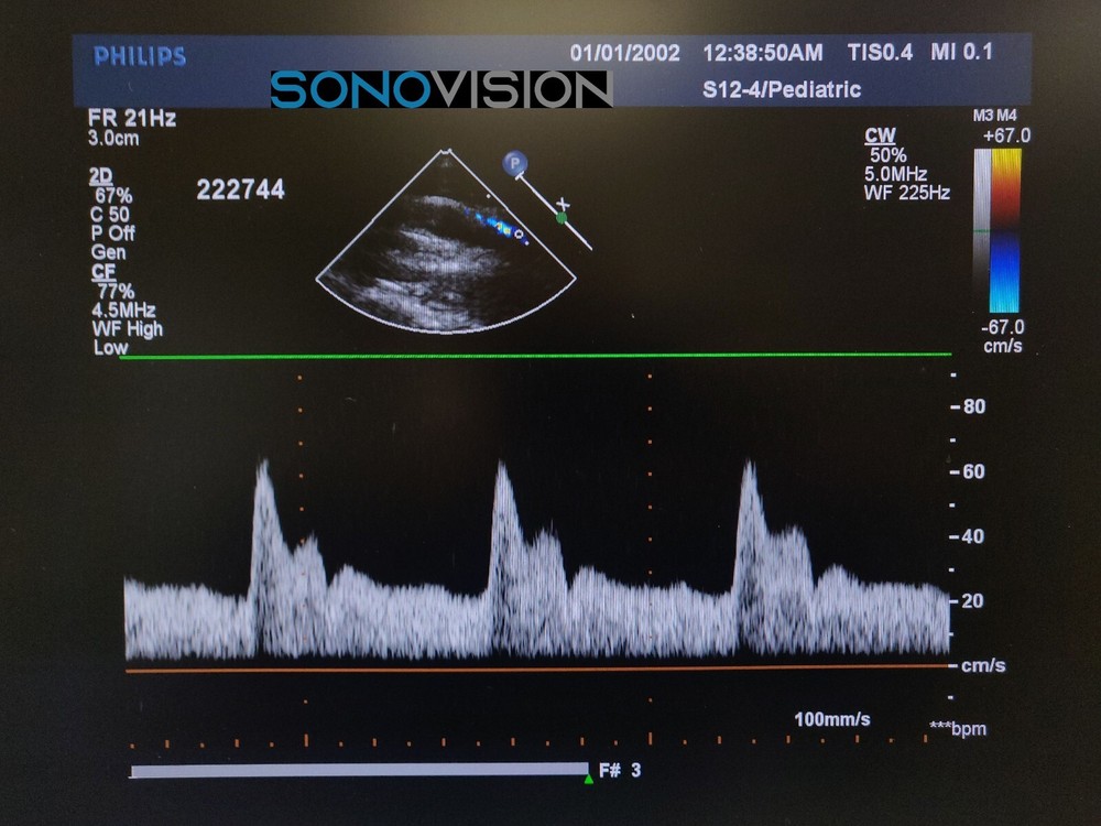 Philips S12-4 (Explora) - 453561270611