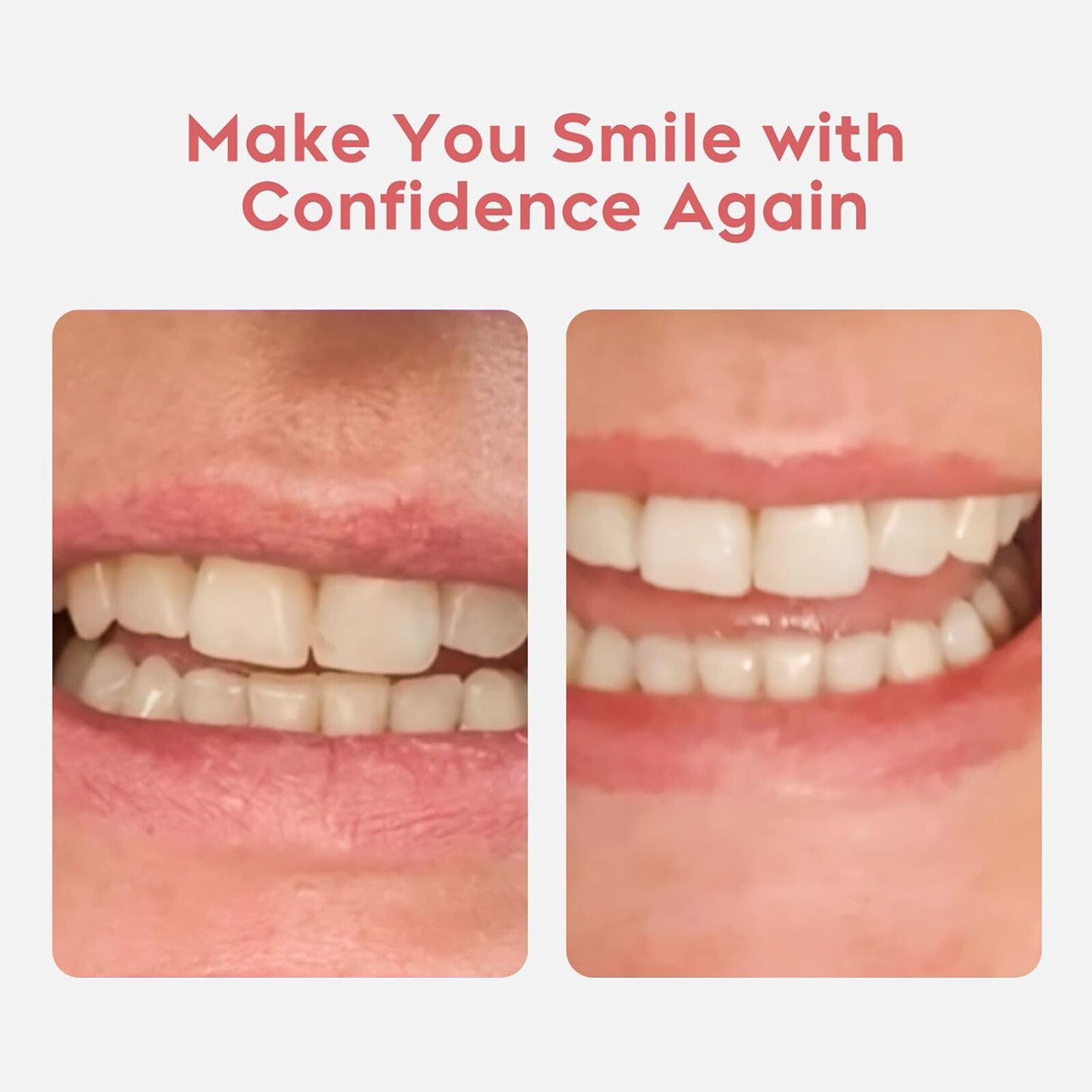 2 Set DIY Dentures Fake Teeth Kits Top and Bottom Dentures Temporary Fake Teeth