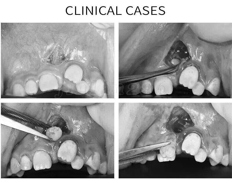 Dental Electro Electrosurgery Unit Machine High Frequency Electric 7pcs Knife US