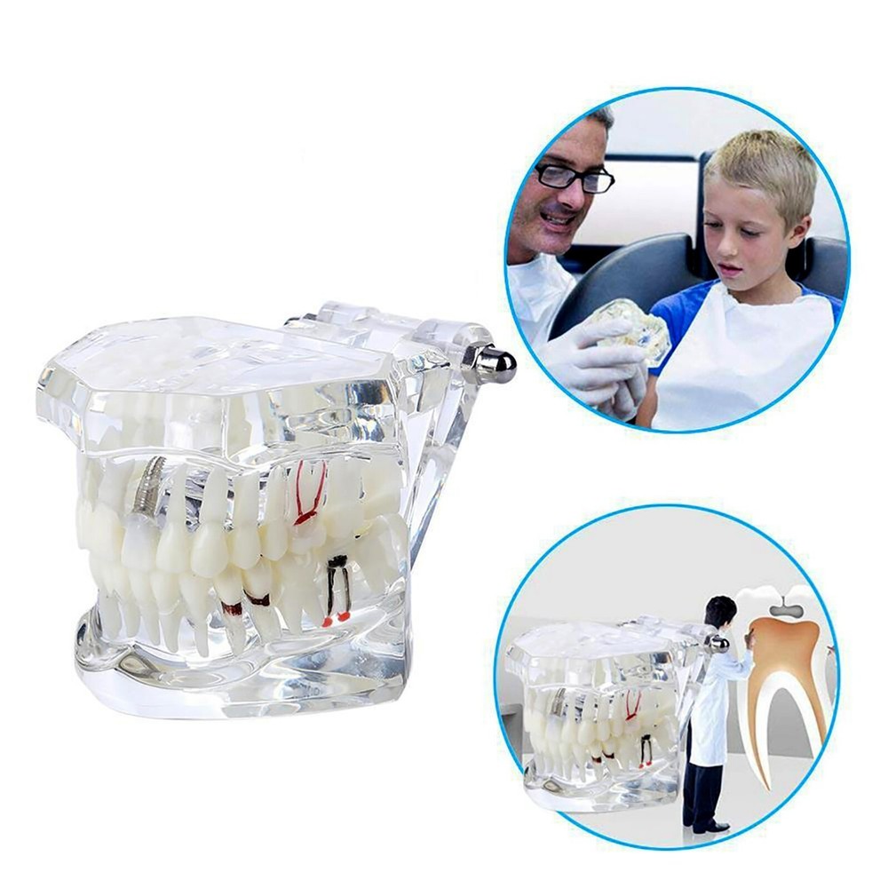 Dental Removable Restoration &Implant Pathological Disease Teeth Study Model